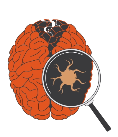 Illustration of a smoldering brain and a magnifying glass showing microglia in the brain